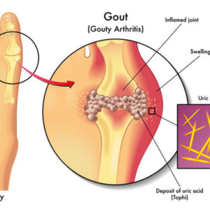 gout