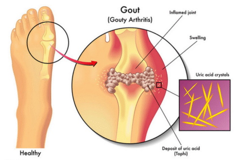 gout